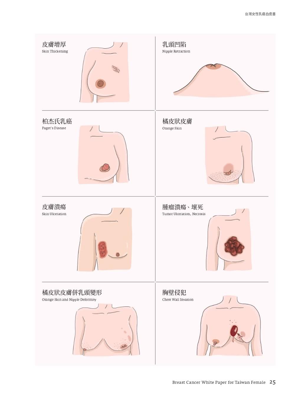 台灣女性乳癌白皮書：100個非知不可的醫學知識 關於妳的乳房 掌上微型Google冊